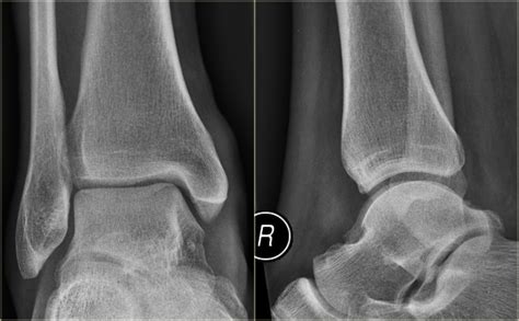 The Radiology Assistant Ankle Special Fracture Cases