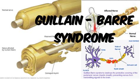 Guillain Barre Syndrome Etiology Pathophysiology Clin Vrogue Co