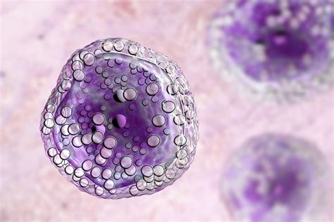 Diffuse Large B Cell Lymphoma Prognosis Rare Disease Advisor
