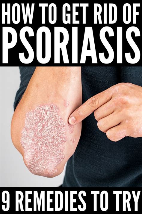 How To Get Rid Of Psoriasis 9 Tips And Remedies To Try In 2020 Psoriasis Remedies Skin