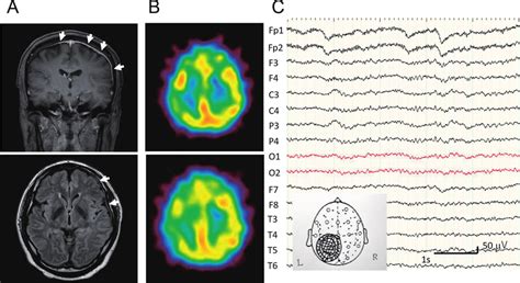 Clinical Images At The Onset Of Hypertrophic Pachymeningitis A