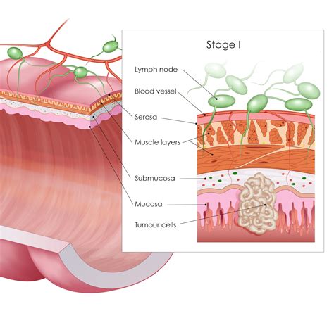 Colorectal Cancer Staging Digestive Cancers Europe