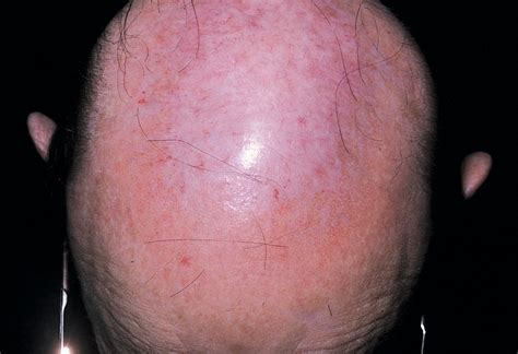 Erosive Pustular Dermatosis Of The Scalp Treatment With Topical