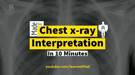 Chest X Ray Interpretation How To Read Chest X Ray In 10 Minutes