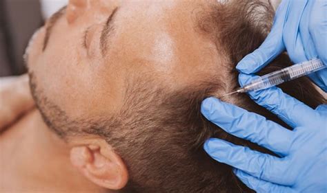 Treatment For Hair Loss Stop Alopecia Areata With Jak Inhibitors
