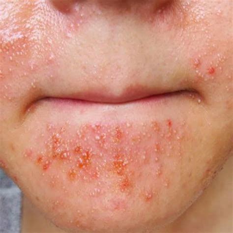 Types Of Bacterial Skin Infections