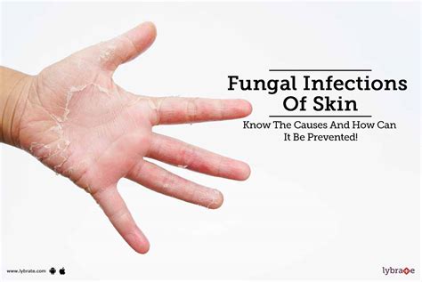 Fungal Infections Of Skin Know The Causes And How Can It Be Prevented