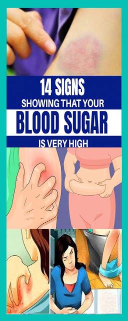 14 Signs Showing That Your Blood Sugar Is Very High Medicine Health Life