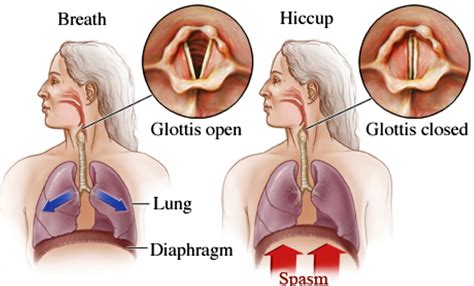 How to calm hiccups in dogs? Hiccups - Causes, Learn How To Stop, Get Rid, and Prevent ...