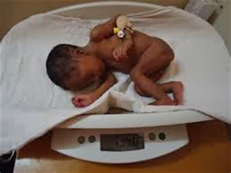 Nursing care of low birth. Isisviews: Human Variation & Race Blog