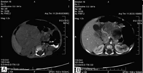 Abdominal Ct Scan Without Contrast A A Well Defined Huge