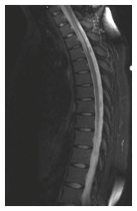 Sagittal View Of The Thoracic Spine Demonstrating Overall Decreased