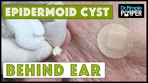 Video Cyst And Blackheads Behind The Ear