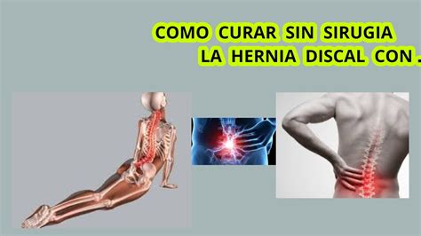 CÓmo Curar Sin CirugÍa Hernia Discal CÓmo Arreglar Las Hernia Discal