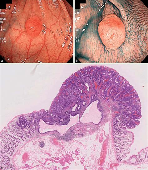 Images From Patient 3 A Conventional Colonoscopy Showing A Protruded