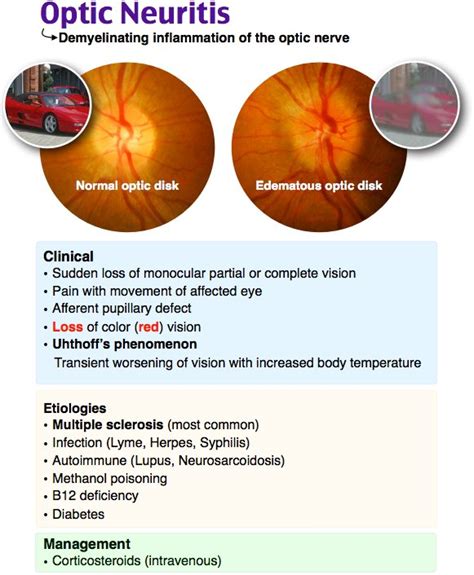 Roshcast On Twitter Optic Neuritis Sudden Monocular Vision Loss With