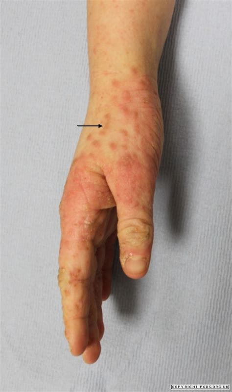 What is scabies in dogs. Scabies | Primary Care Dermatology Society | UK
