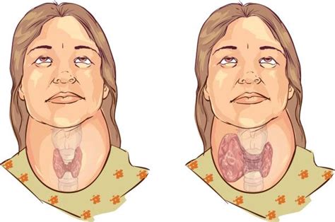 How To Treat Goiter With And Without Surgery Wound Care Society