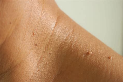 Skin Tag Removal Vida Dermatology