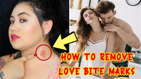 How To Remove Love Bite Marks Fast Home Remedies For Love Bite Marks Removal Youtube