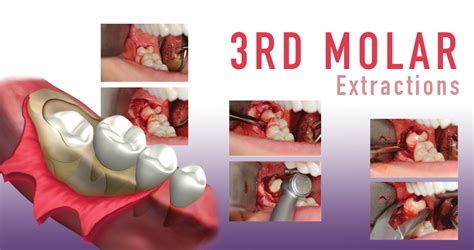 Oral Surgery 3rd Molar Extraction Ihds Ph