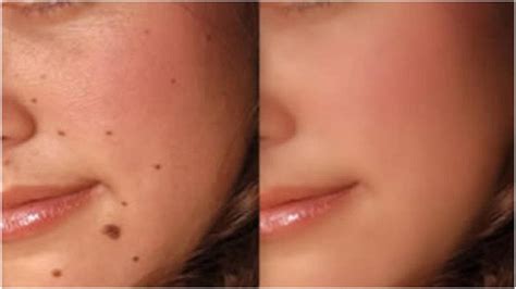 #skincare #chrisgibson #moles in this video i give you an all natural and painess ay to remove moles, warts,and skin tags. Mole Removal at Home | Mole Removal On Face at Home - YouTube