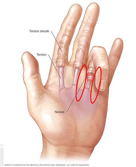 3 Tips To Treat Trigger Finger Yourself Rehab For A Better Life