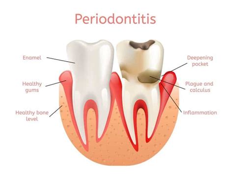 Bleeding Gum Dentist 3 Stages Of Periodontal Disease Know The Signs