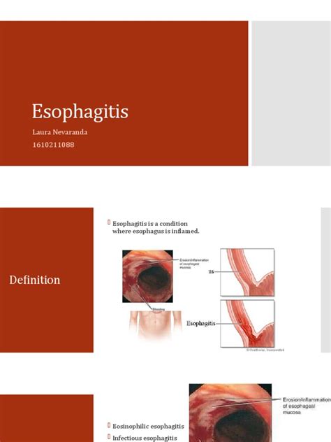 A Comprehensive Overview Of Eosinophilic Esophagitis Definition Types