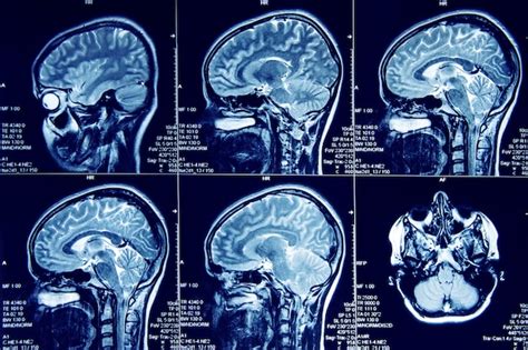 Premium Photo Magnetic Resonance Imaging Of Human Brain In Sagittal