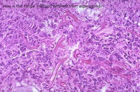 Clinical presentation the presentation can vary, ranging from exophthalmos, rhinorrhea, and ophthalmoplegia with loss of visual acuity and peripheral faci. L-19 pathology of CNS infections - Neurology Na with Na at ...