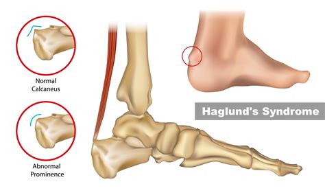 Haglunds Deformity Frisco Foot Ankle Specialists