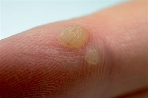 Photo Gallery Of Warts On Different Body Parts