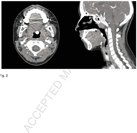 Figure 2 From Case Presentation And Images Of A Lingual Osseous