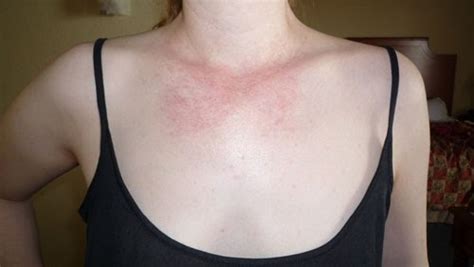 Symptoms Causes Treatment Of Disease Itchy Neck