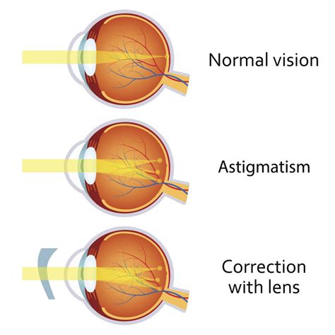 Astigmatism What Is It Pacific Vision Institute Articles