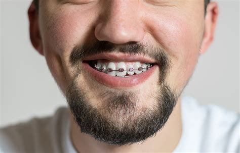 Braces For Adults When Are You Too Old For Treatment