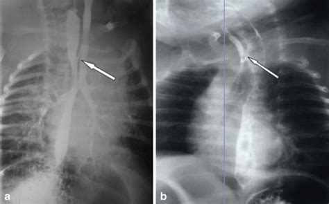 Tracheoesophageal Fistula Radiology