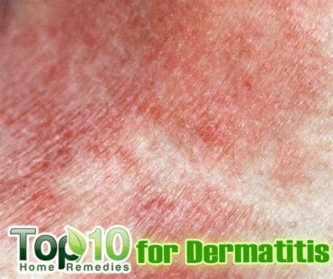 Home Remedies For Dermatitis Top 10 Home Remedies