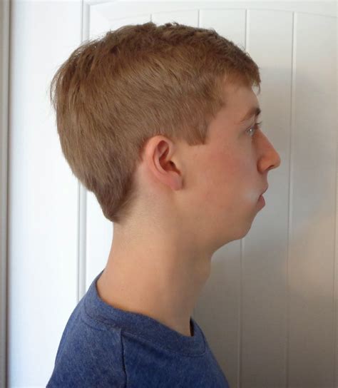 How To Correct A Receding Jawline Justinboey