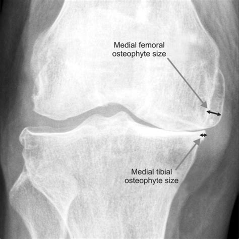 Measurement Of Medial Femoral Osteophyte Size And Medial Tibial