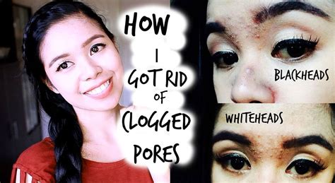 How I Got Rid Of My Clogged Pores Black Heads White Heads On Forehead