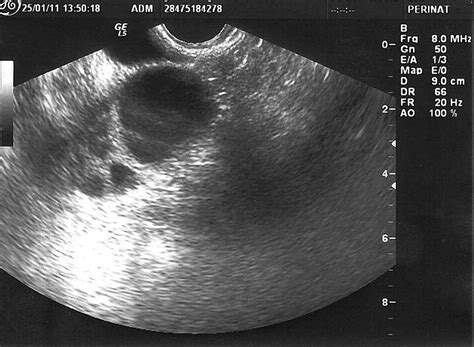 Ectopic Ovary Confirmed By Ovarian Stimulation In A Case Of Unicornuate