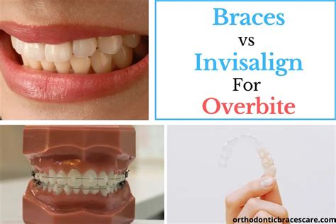 Braces Vs Invisalign For Fixing An Overbite Orthodontic Braces Care