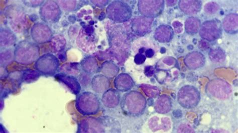 Tangible Body Macrophages In Lymph Node Cytology Youtube