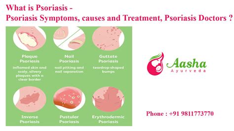What Is Psoriasis Psoriasis Symptoms Causes And Treatment Psoriasis