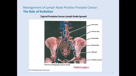 Management Of Lymph Node Positive Prostate Cancer The Role Of Radiation Youtube