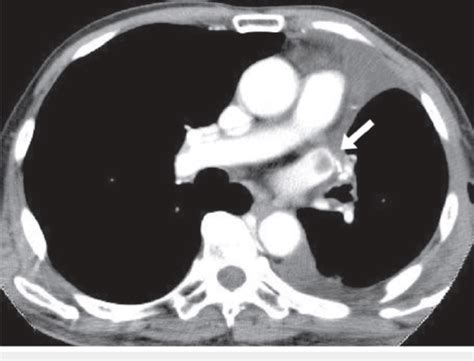 Ct Scan Of The Chest With Iv Contrast A Thrombus White Arrow In The