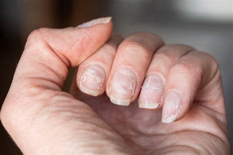 Possible Causes And Treatment Of Fingernails Falling Off Newslodge