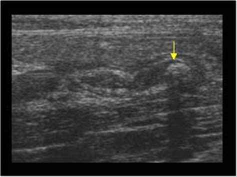 Abdomen And Retroperitoneum 15 Appendix Case 152 Uncomplicated